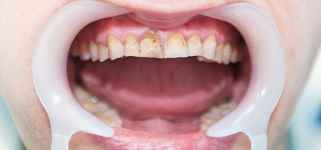 Dientes con fluorosis