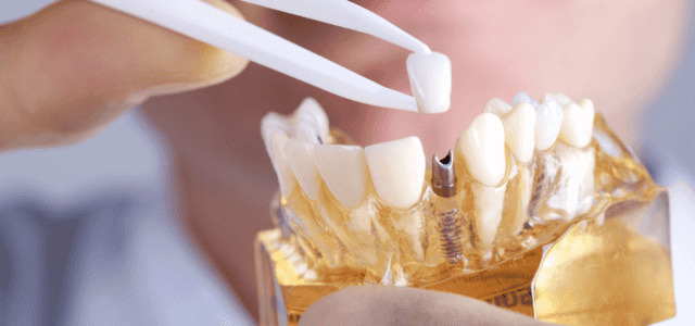 Cómo se pone un implante dental
