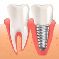 Gingivitis de los implantes