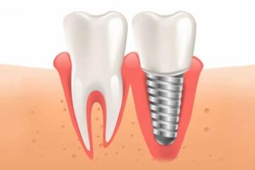 Gingivitis de los implantes