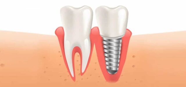 Mucositis en implantes Gingivitis de los implantes