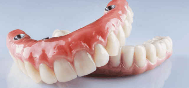 Prótesis dentales sobre implantes