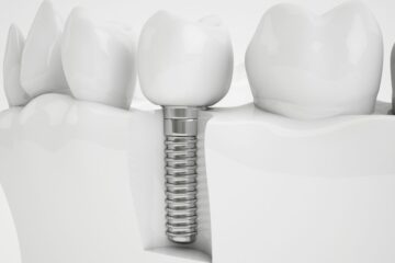 Aparece una infografía de un implante straumann