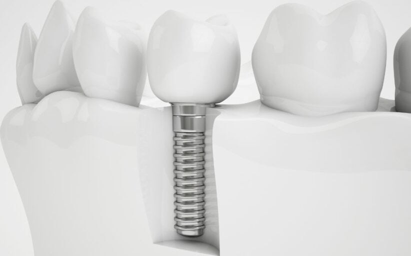 Los implantes straumann son una gran opción para la rehabilitación oral Aparece una infografía de un implante straumann
