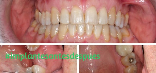 implantes antes despues boca implantes antes despues