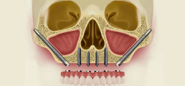 Implantes cigomáticos técnica