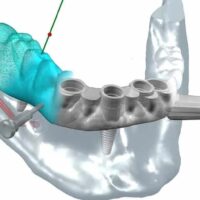 Poner implantes dentales en un día