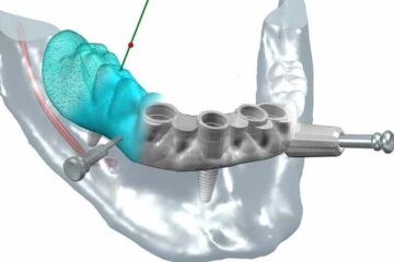 Poner implantes dentales en un día