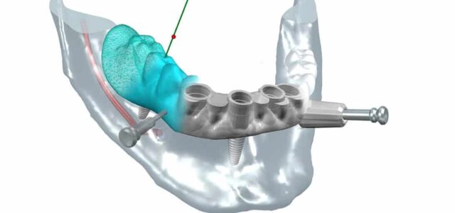 Implantes de carga inmediata Poner implantes dentales en un día