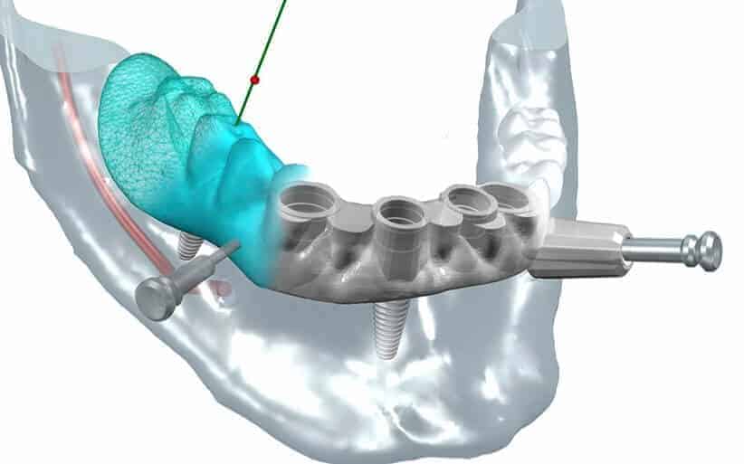 Implantes de carga inmediata Poner implantes dentales en un día