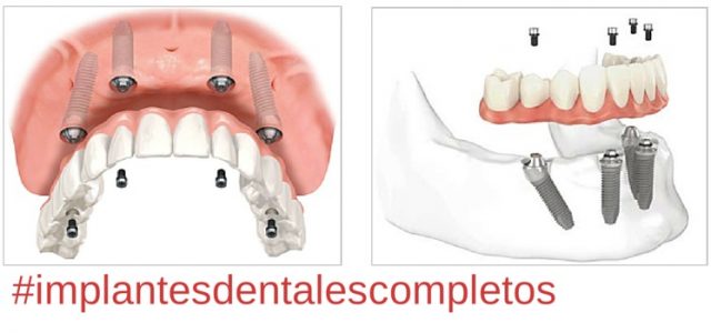 cuanto cuesta una dentadura completa en argentina
