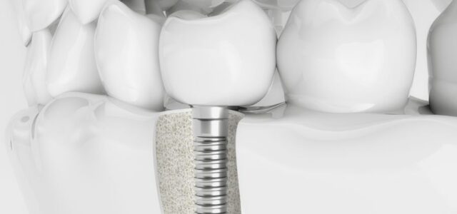 De qué material son los implantes dentales y por qué se usa titanio Modelo anatómico con un implante dental de titanio insertado en la encía, mostrando de qué material son los implantes dentales y su estructura interna.