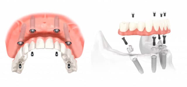 Colocación de implantes dentales