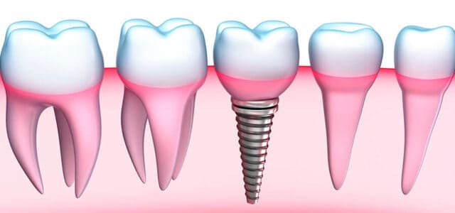 Implante tras perder diente