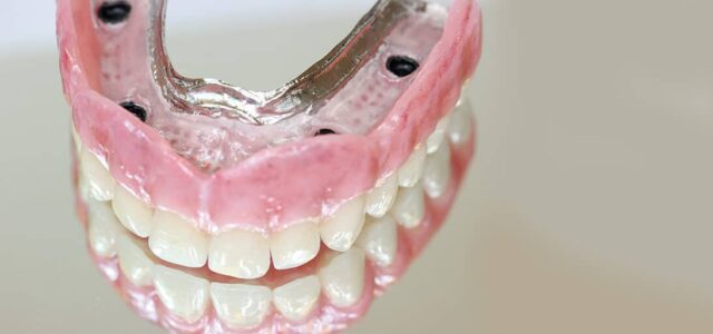 básico transatlántico La risa Precio de los implantes dentales para toda boca | 2022 | Ferrus&Bratos