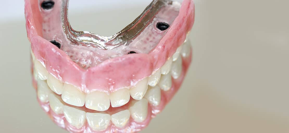 Aplaudir alivio Mejorar Precio de los implantes dentales para toda boca | 2023 | Ferrus&Bratos