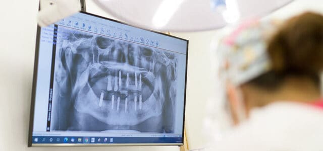Implantes dentales en toda la boca