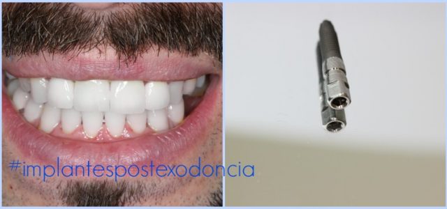 implantes postexodoncia implantes dentales extraccion