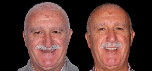 Los implantes con poco hueso en Madrid ofrecen resultados excelentes