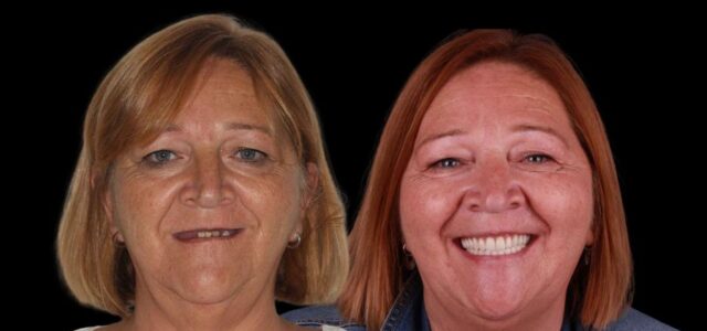 Foto de antes y después de un paciente real con implantes straumann