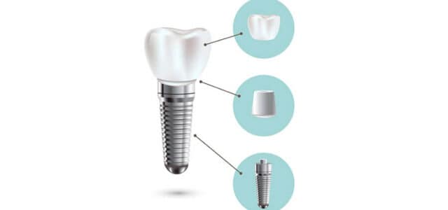 Implantes dentales Straumann