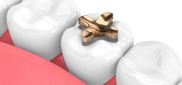 Molar con incrustación
