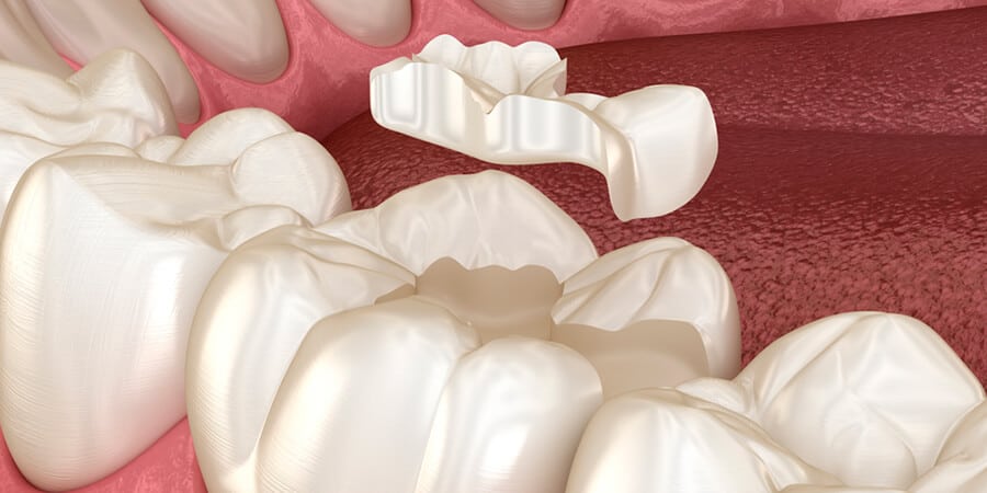 Muela rota: ¿cómo se puede tratar? | Ferrus&Bratos