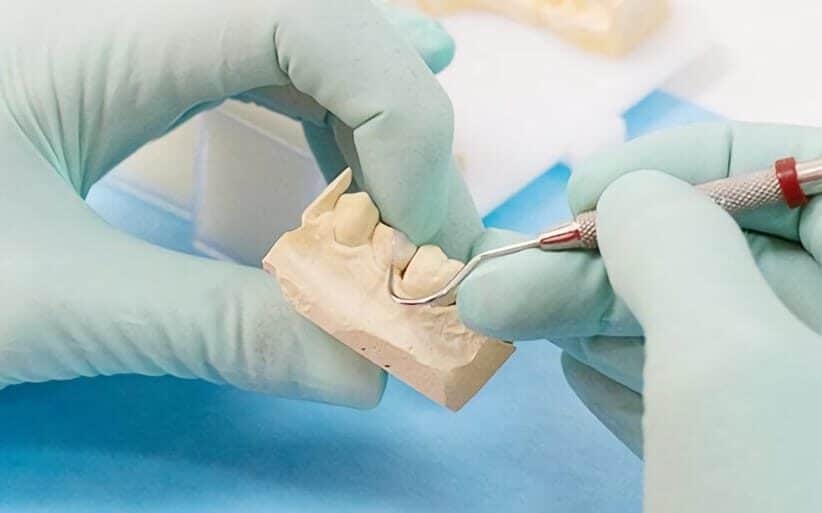 Cómo es una incrustación dental Retirar una incrustación dental