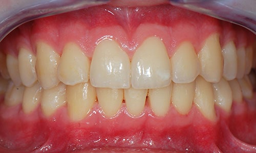 dolor de encias dientes y cabeza
