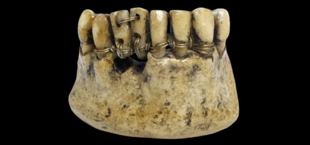 En un principio la ortodoncia ofrecía opciones de brackets menos estéticos La evolución de la ortodoncia ha transformado los brackets metálicos en brackets estéticos