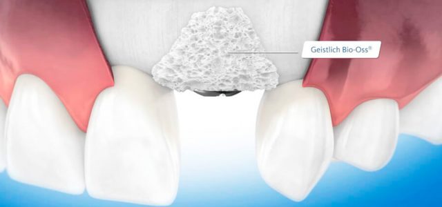 Sistema para pacientes con implante