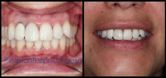 injerto hueso mandibular injerto hueso mandibular