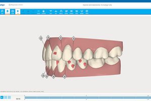 Dientes al terminar el tratamiento con Invisalign