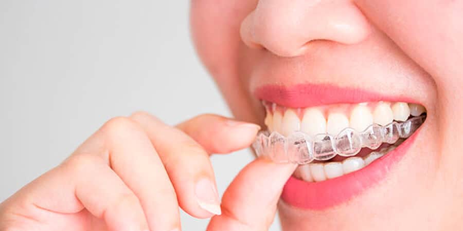 Memorizar suficiente No lo hagas 💰 El precio de la ortodoncia invisible【2020】| Ferrus&Bratos