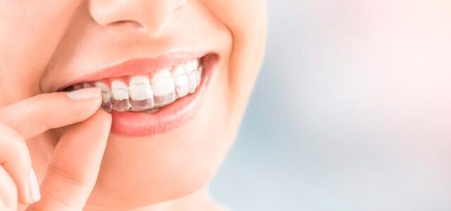 Cómo funciona Invisalign Férulas removibles