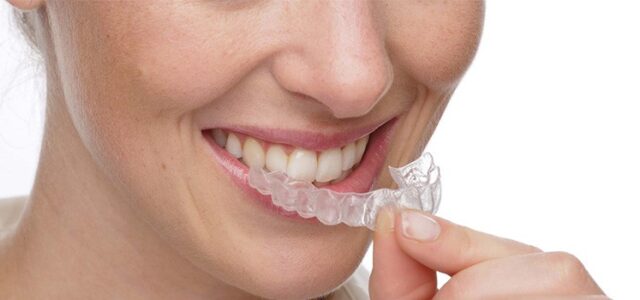 Invisalign las 6 razones por las que lo elegirás