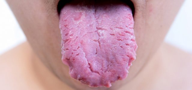 Tratamiento para la candidiasis en la lengua