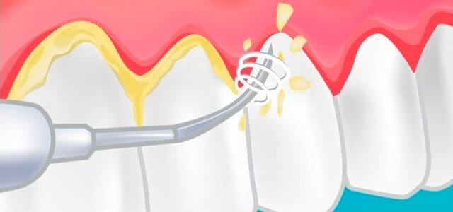 El limpieza dental | | Ferrus&Bratos