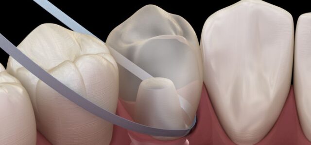 Aparece una foto de cómo limpiar tus implantes con hilo dental