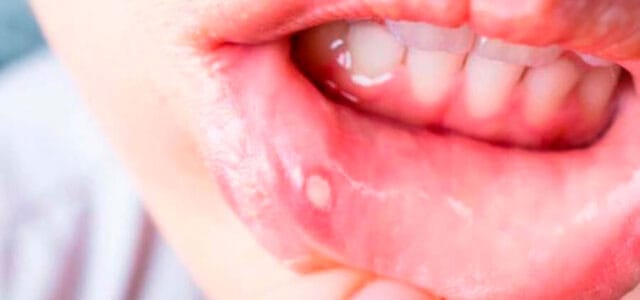 Herpes en la boca: remedios para aliviar el picor y hacerlo desaparecer
