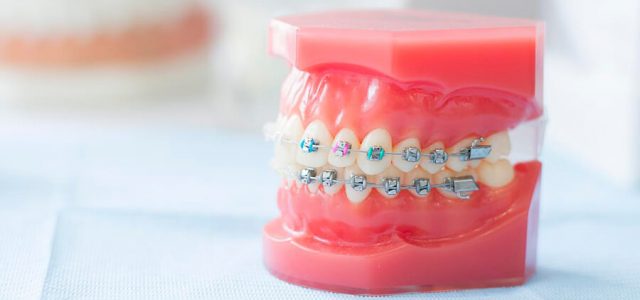 Los brackets crean úlceras bucales