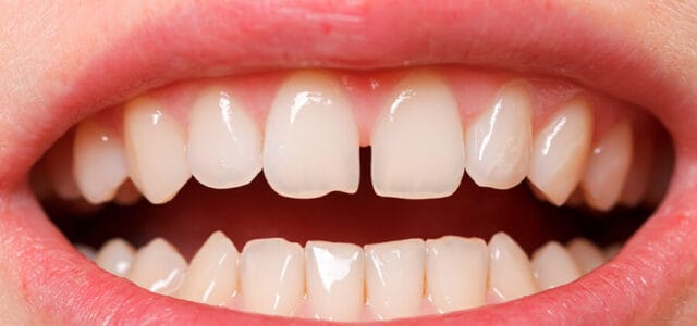 Separación en los dientes