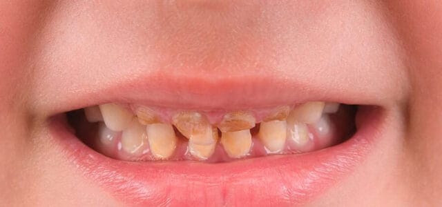 Caries en dientes de leche