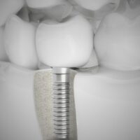 Modelo dental que muestra la estructura interna de un implante, ilustrando de qué material son los implantes dentales y su integración con el hueso.