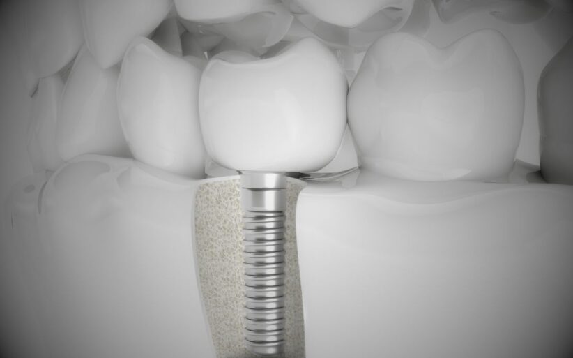 Modelo dental que muestra la estructura interna de un implante, ilustrando de qué material son los implantes dentales y su integración con el hueso.