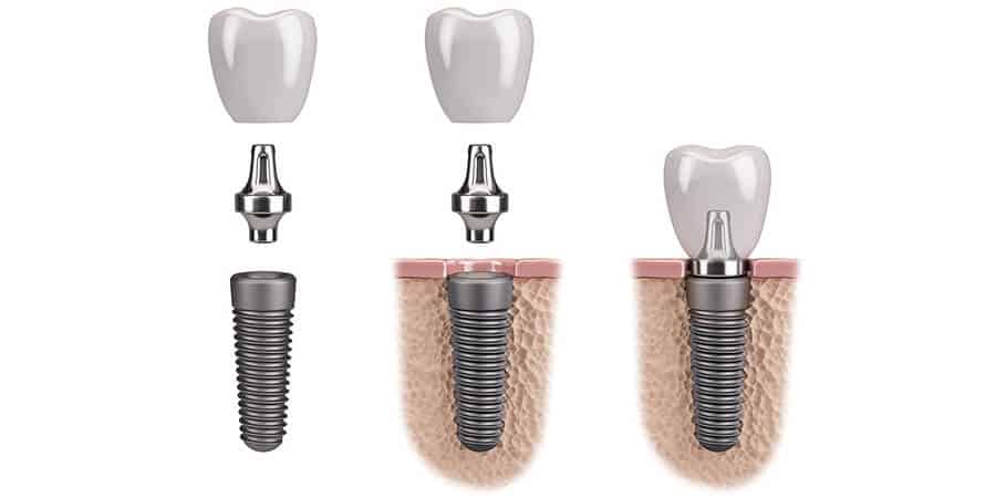 Partes de un implante dental