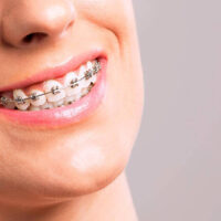 Los brackets duelen