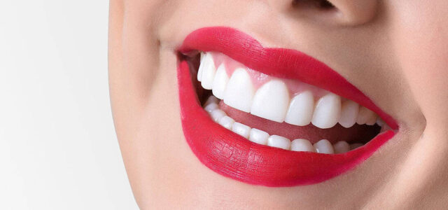 Microcarillas dentales Microcarillas