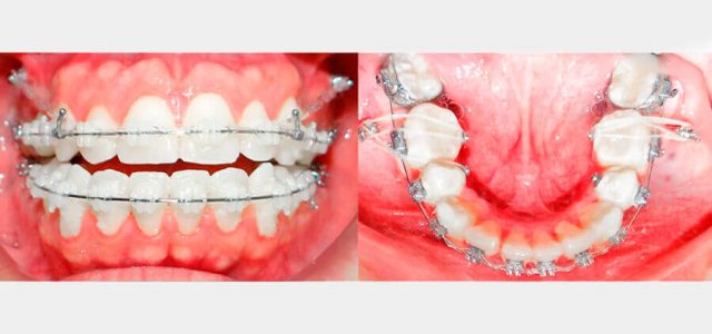 Tornillos de titanio con brackets zafiro