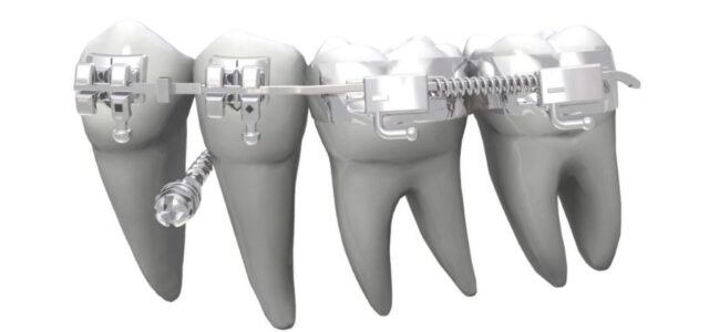 Dientes con brackets y un microtornillo de ortodoncia como anclaje entre dientes
